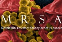 Pengertian Infeksi bakteri Methicilin Resistant Staphylococcus Aureus (MRSA)